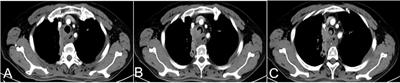 Transarterial infusion chemotherapy for advanced esophageal cancer with airway stenosis